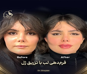 تزریق ژل لب
