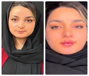 تزریق ژل لب