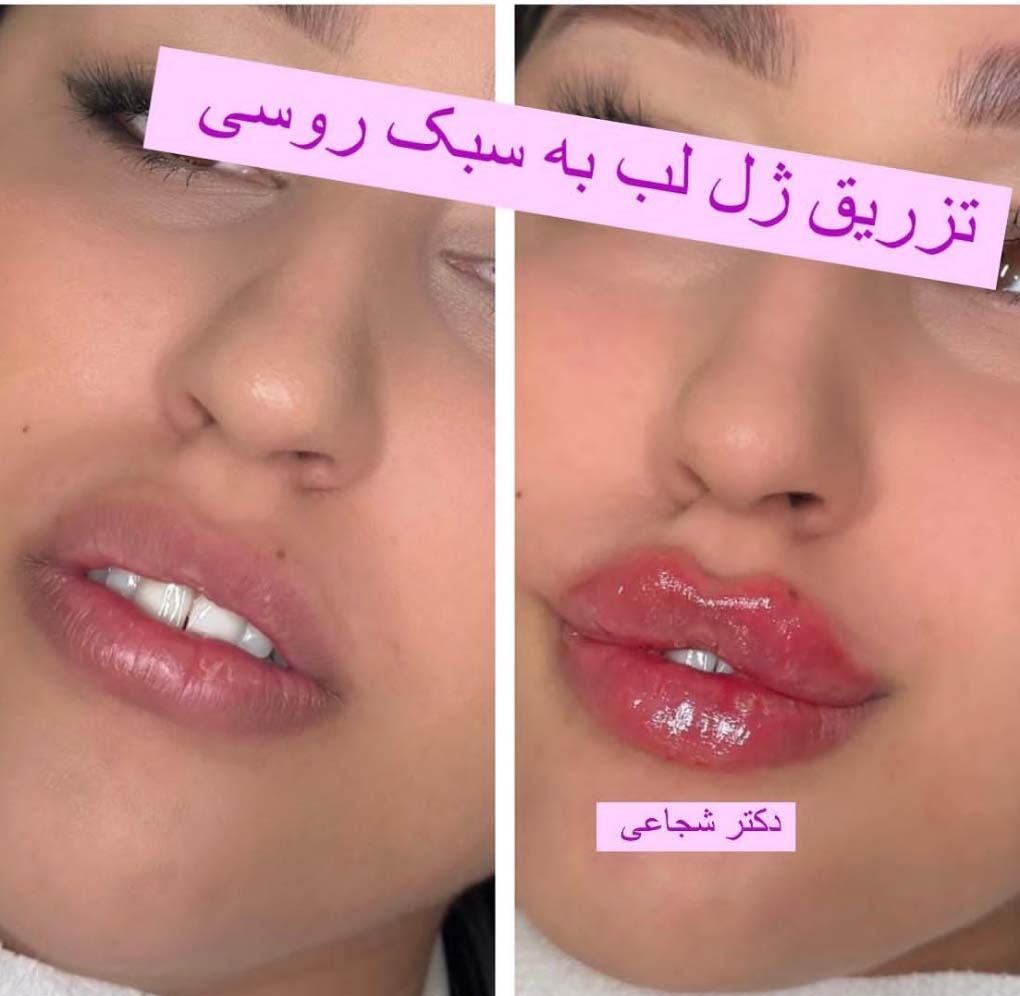 ژل لب روسی
