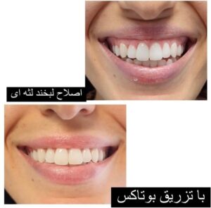 بوتاکس لبخند لثه ای