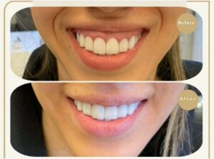 بوتاکس لبخند لثه ای