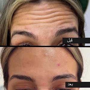 بوتاکس پیشانی