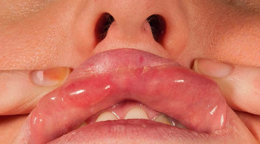 آنزیم تخلیه ژل