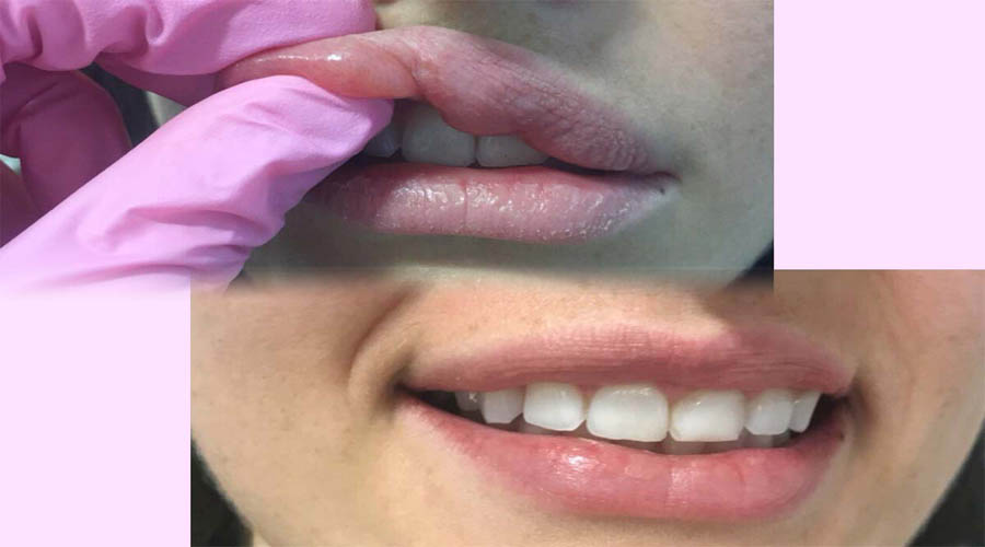 آنزیم تخلیه ژل