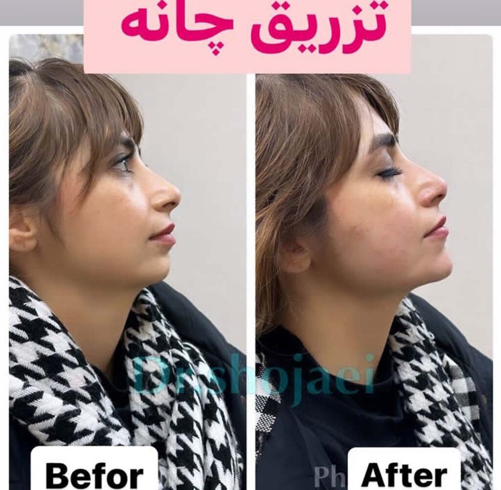 زاویه سازی صورت