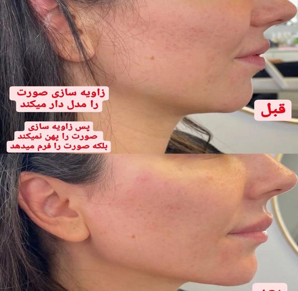 زاویه سازی صورت