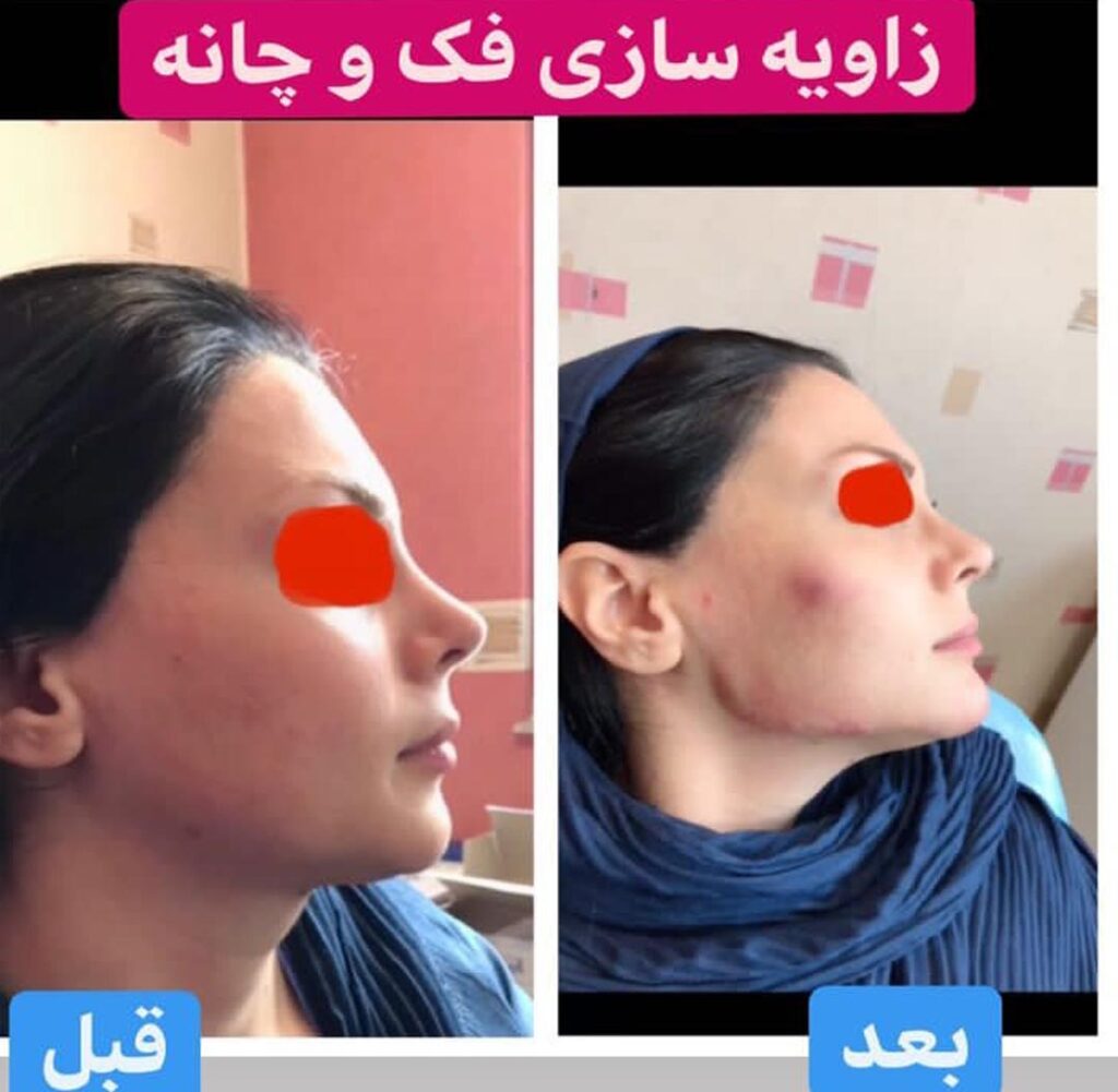زاویه سازی صورت