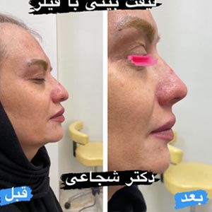 لیفت بینی