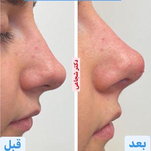 لیفت بینی