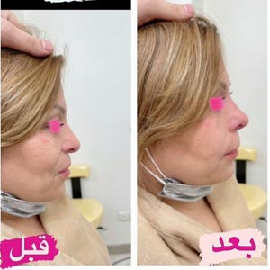 لیفت بینی