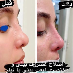 لیفت بینی