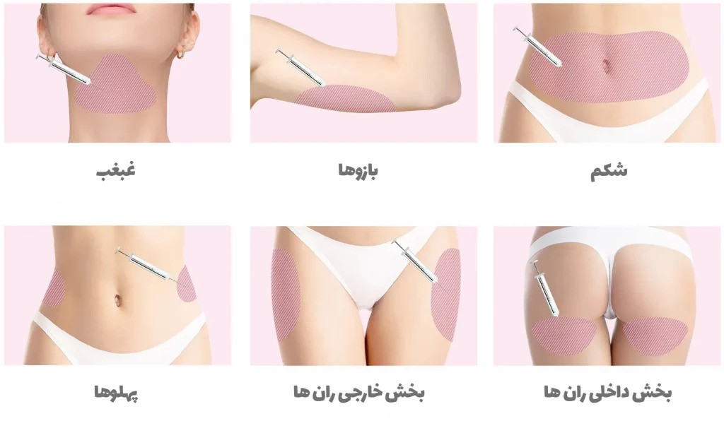 مزوتراپی لاغری