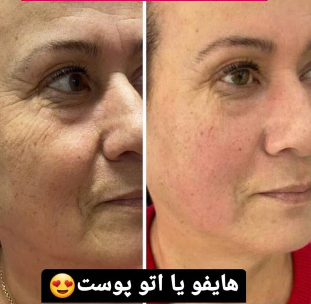 هایفوتراپی