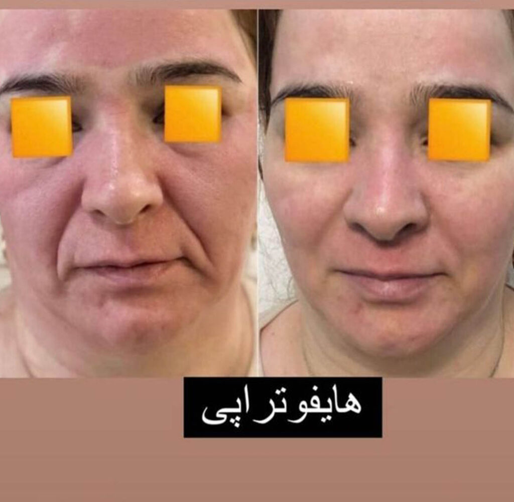 هایفوتراپی
