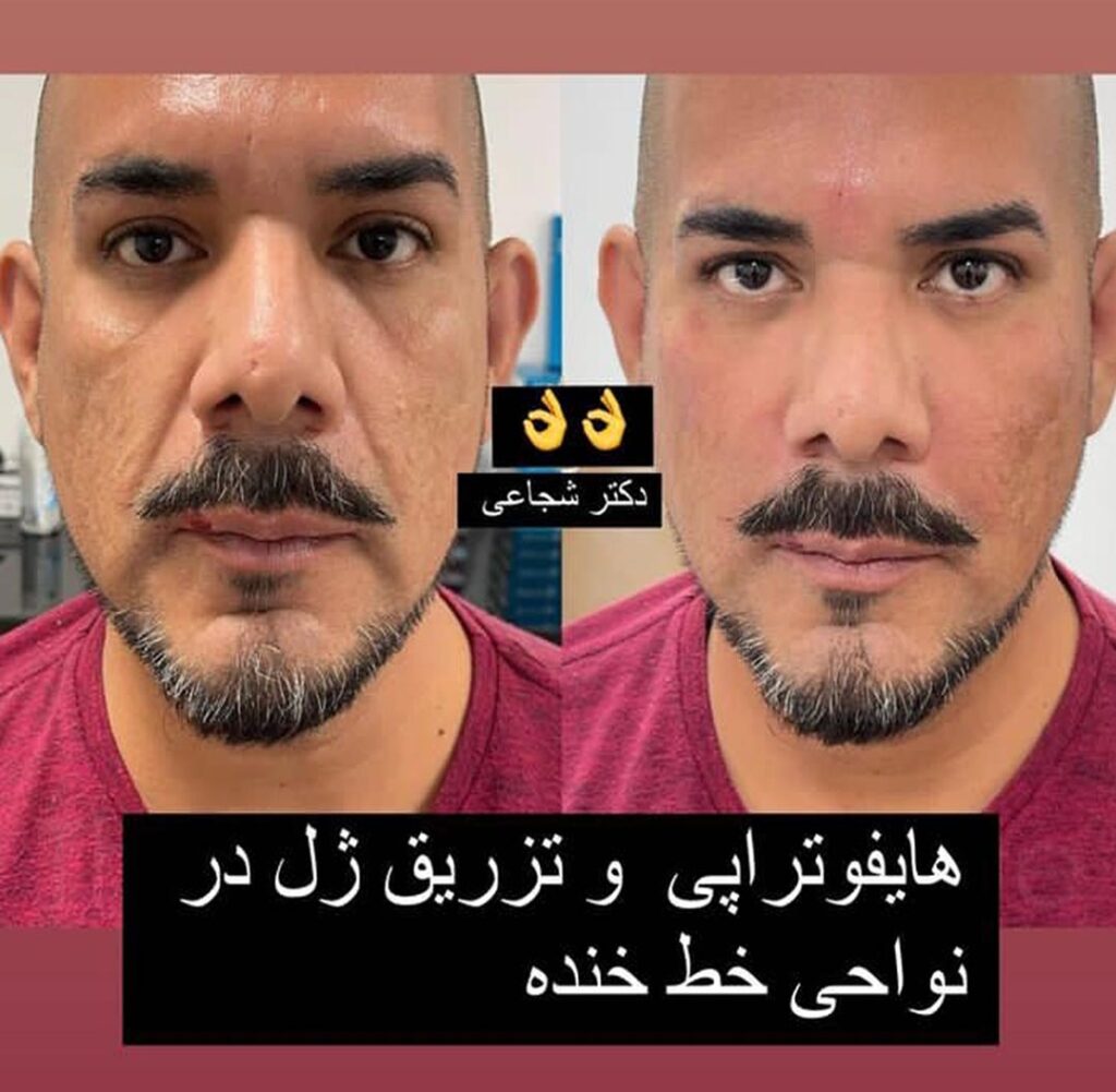 هایفوتراپی