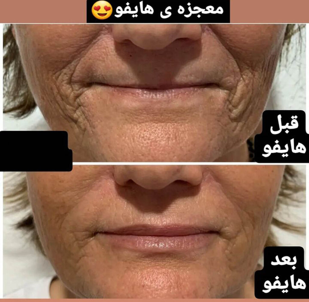 هایفوتراپی