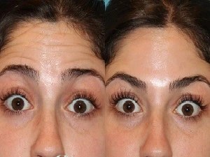 تزریق بوتاکس پیشانی برای کاهش چین و چروک صورت