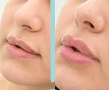 تزریق ژل توسط دکتر محمدرضا شجاعی