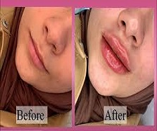 تزریق-ژل-لب